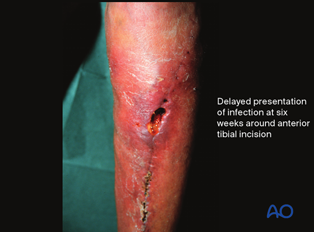 classifications of wound infection