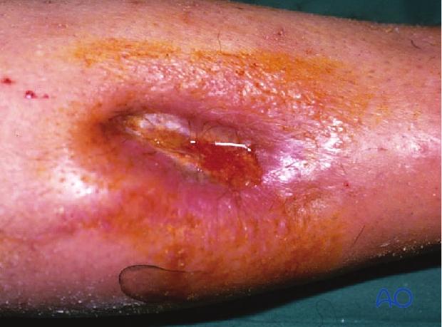 Adequate, timely débridementdebridement is the most important element of the treatment of a fracture-site infection.