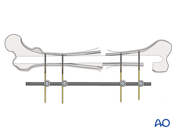 An external fixator should be applied for stability, if the fracture is not healed.