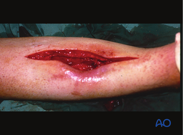 prevention of infection