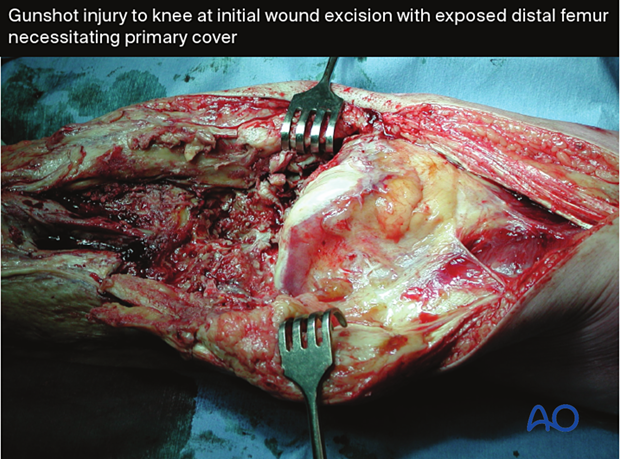 prevention of infection