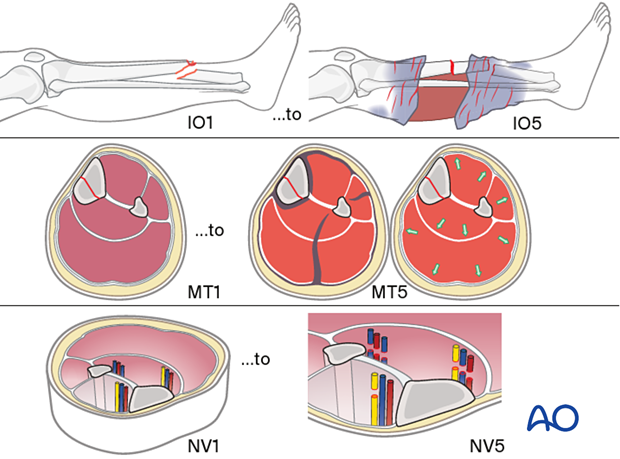 The AO classification of fracture wound severity provides a grading system