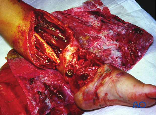 Open fracture of the tibia