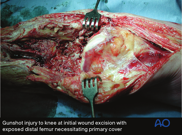 When an open fracture communicates with a joint cavity, special surgical tactics are required.
