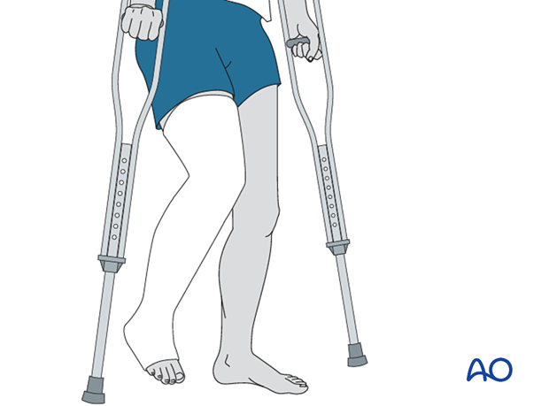 42_X110_i040 fracture management with limited resources