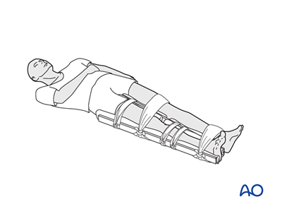 Drapability Splint Fracture management with limited resources