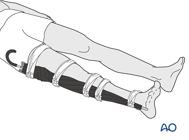 42_X110_i120 First aid for tibial fractures