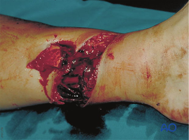 42_X110_i140 fracture management with limited resources – open fractures