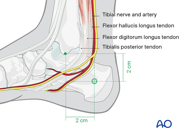 42_X110_i160 Calcaneal pin insertion