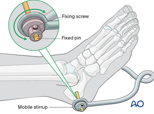 42_X110_i180 Calcaneal pin insertion