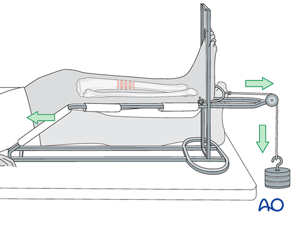 42_X110_i200 Calcaneal traction and Braun frame