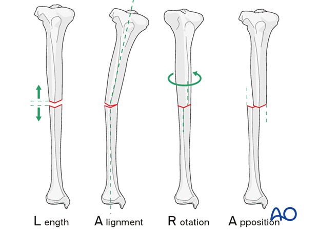 42_X110_i280 Tibial fracture reduction principles