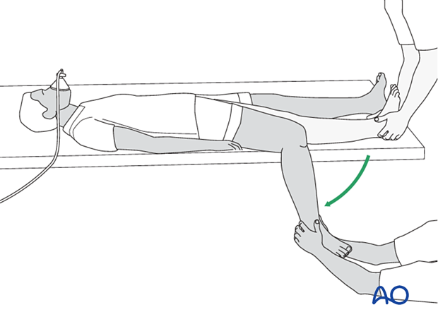 42_X110_i300 Tibial fracture reduction