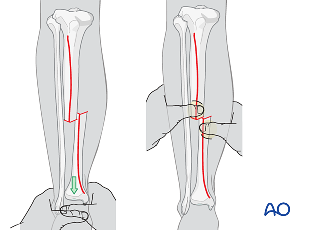 42_X110_i340 Tibial transverse fracture, manual reduction
