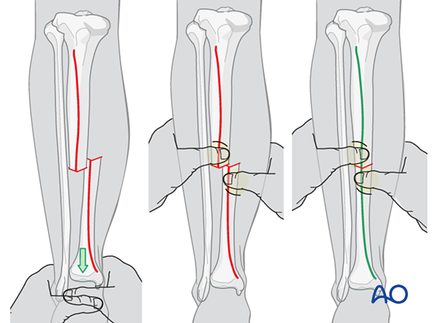 42_X110_i360 Tibial transverse fracture, rotation and apposition