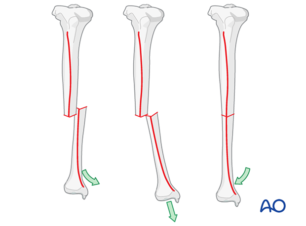 42_X110_i380 Tibial transverse fracture, rotation and apposition