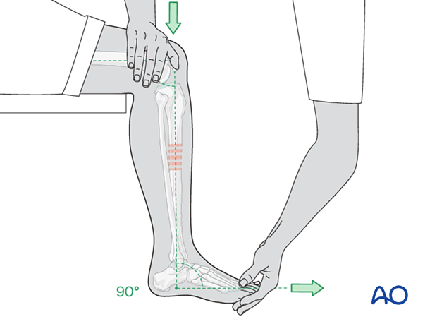 42_X110_i400 Tibial fracture, cast application