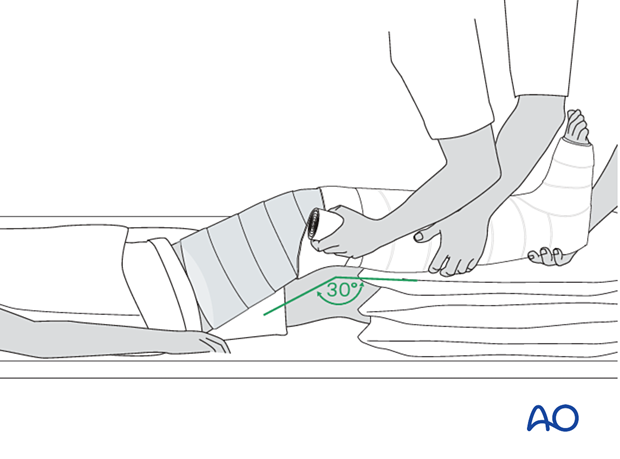 42_X110_i500 Cast application, extension to the thigh