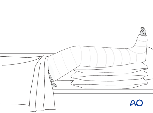 42_X110_i540 Cast application, drying of the cast