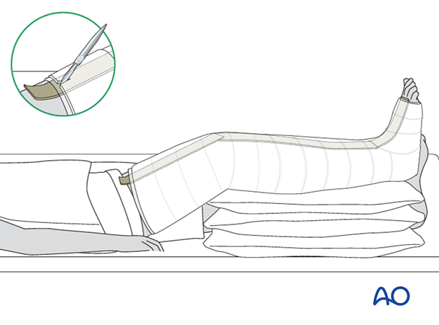 42_X110_i560 Cast application, splitting of plaster
