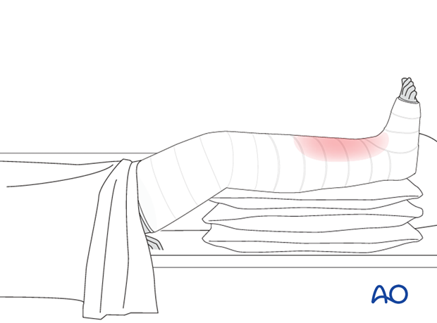 42_X110_i600 Tibia cast application, compartment syndrome