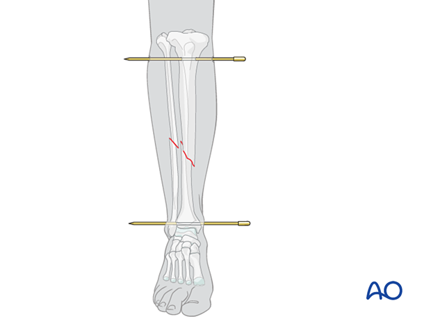 42_X110_i620 Cast application, pins in plaster