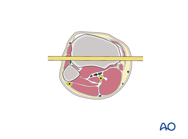 42_X110_i640 Cast application, pins in plaster