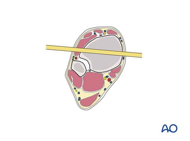 42_X110_i660 Cast application, pins in plaster