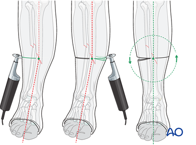 Fracture management with limited resources