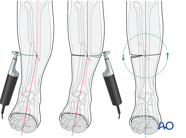42_X110_i700 Cast application, central wedging