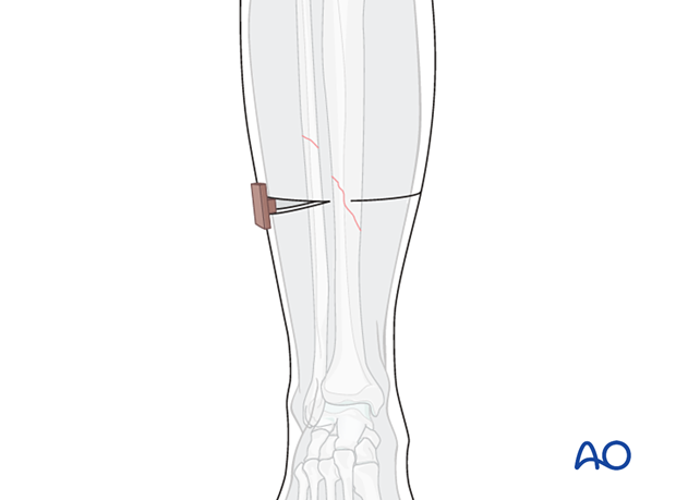 42_X110_i710 Cast application, central wedging