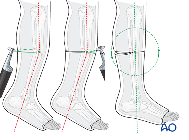 42_X110_i720 Cast application, central wedging