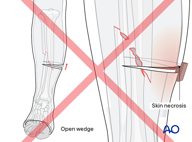 42_X110_i740 Cast application, central wedging skin necrosis
