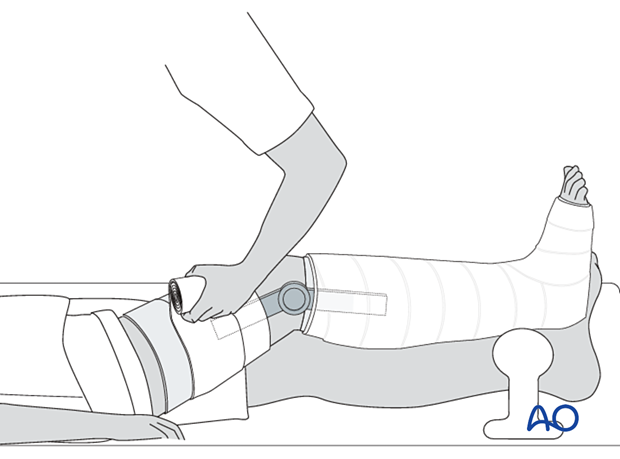 42_X110_i840 fracture management with limited resources, alternative cast for weight bearing