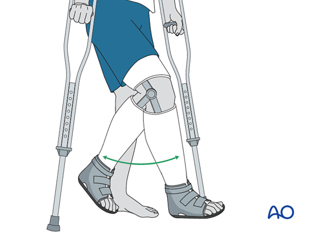 42_X110_i860 fracture management with limited resources, alternative cast for weight bearing