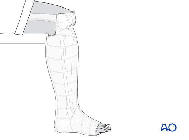 42_X110_i880 fracture management with limited resources, patellar tendon bearing cast