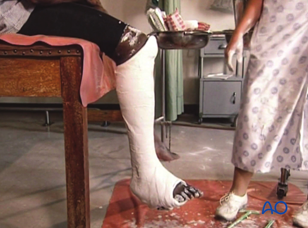 42_X110_i960 fracture management with limited resources, Sarmiento cast