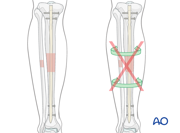42_X120_i010 Intramedullary (IM) nailing is the first treatment choice for most tibial shaft fractures.