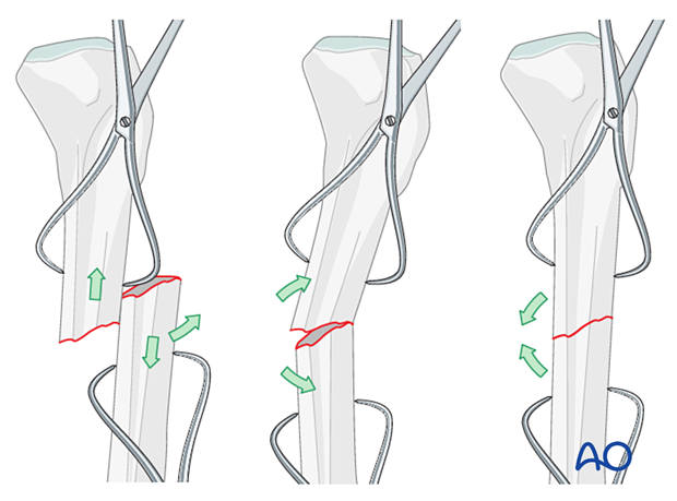 42_X120_i080 Reduction of transverse fracture
