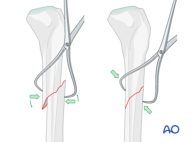 42_X120_i090 Reduction with bone clamp