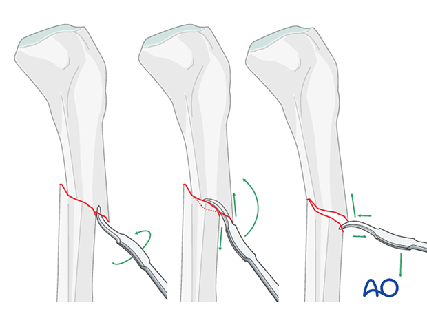 42_X120_i100 Reduction with Hohmann retractor