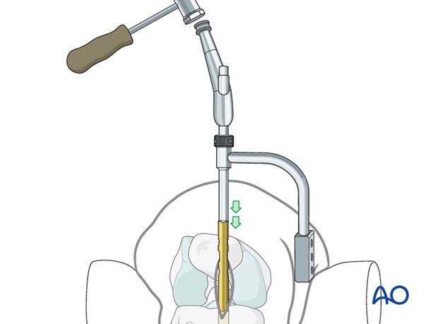 42_X120_i130 Nail insertion