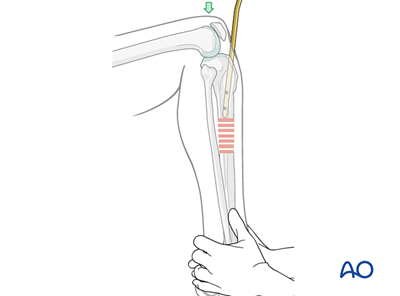 Nail Inposed Nailing without image intensification