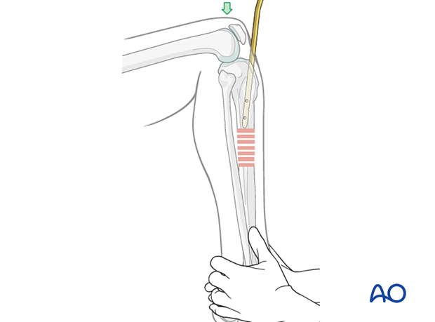 42_X120_i140 Stabilize the foot on the OR table to maintain reduction without distraction as the nail is advanced.