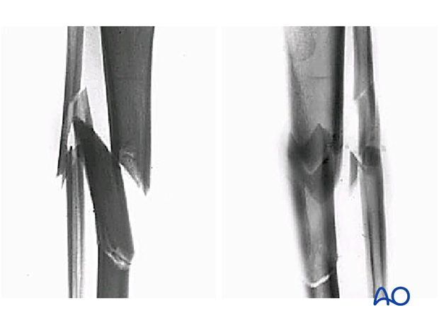 Multifragmentary fracture, intact segmenta