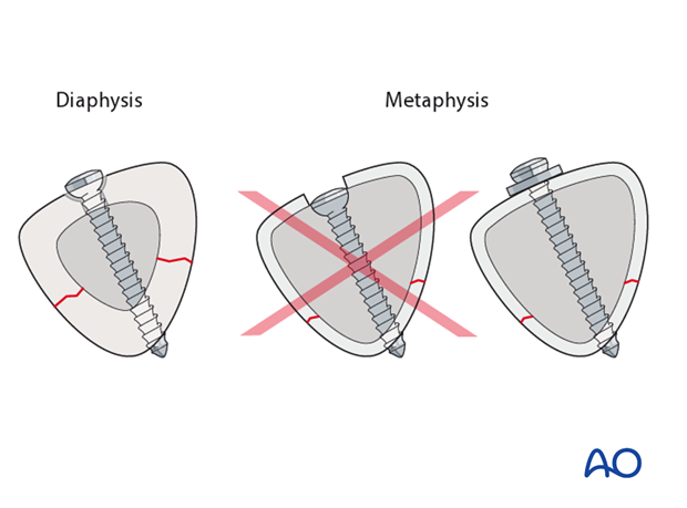 No countersinking in the metaphysis