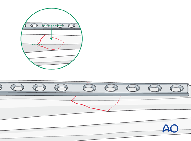 Confirming fracture plane