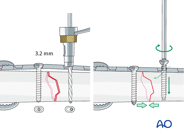 Axial compression with eccentric screw