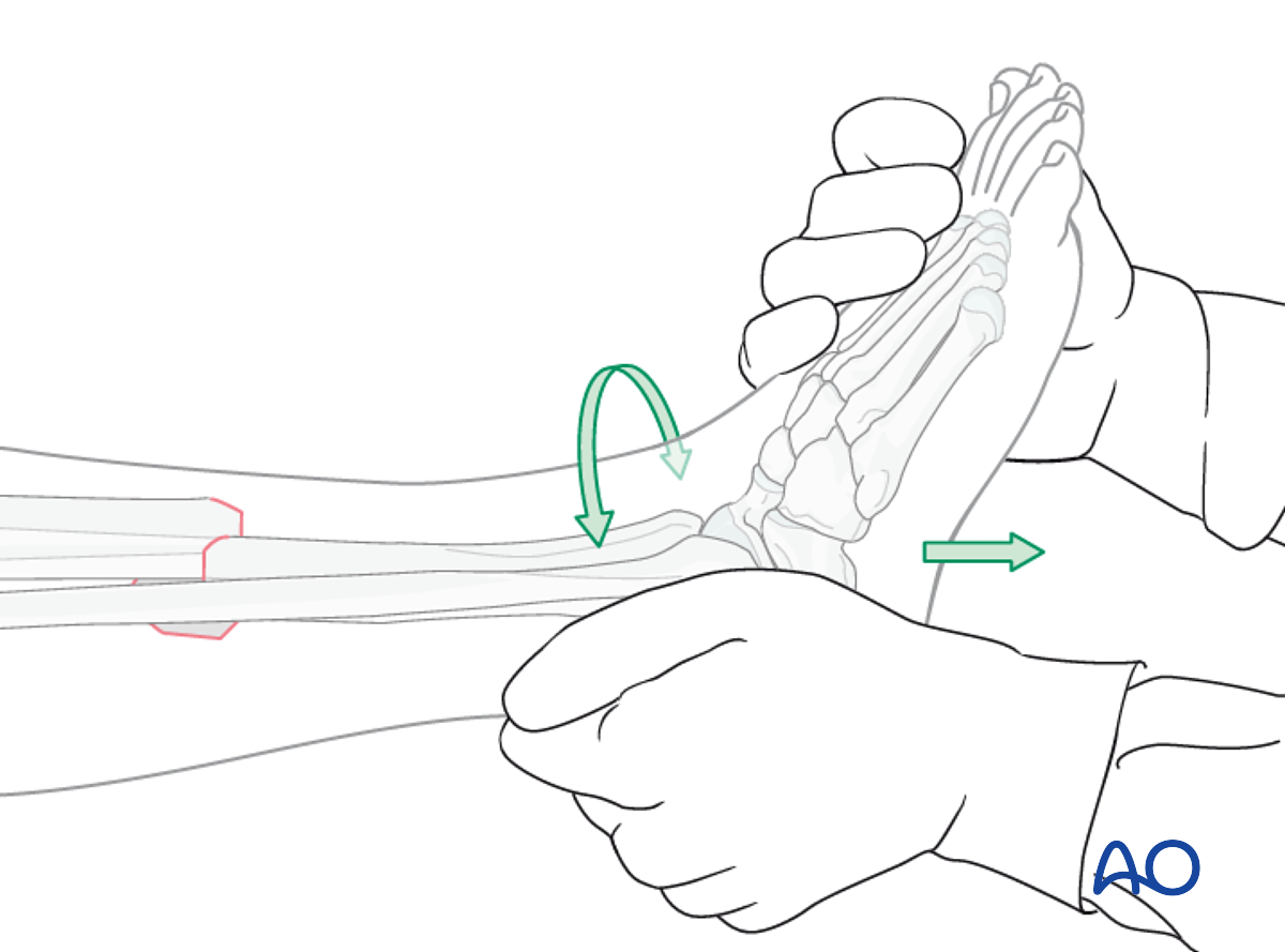 MIO - Bridge Plating For Wedge Fracture, Fragmentary Wedge