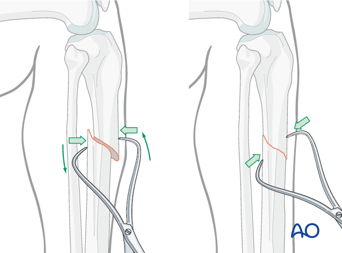 Aggregate 132+ closed reduction and percutaneous nailing best - ceg.edu.vn